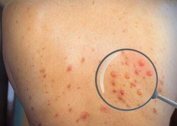 Monkeypox: A Rare Viral Infection and Its Key Symptoms 4 Monkeypox: A Rare Viral Infection and Its Key Symptoms