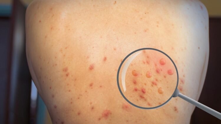 Monkeypox: A Rare Viral Infection and Its Key Symptoms 1 Monkeypox: A Rare Viral Infection and Its Key Symptoms
