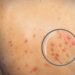 Monkeypox: A Rare Viral Infection and Its Key Symptoms 8 Monkeypox: A Rare Viral Infection and Its Key Symptoms