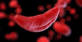 Sickle Cell Patient Dies After Allegedly Failing to Receive Blood Despite Availability; Questions Raised Over Hospital Procedures 2 Sickle Cell Patient Dies After Allegedly Failing to Receive Blood1